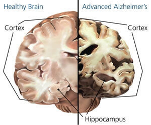 gehirn-alzheimer