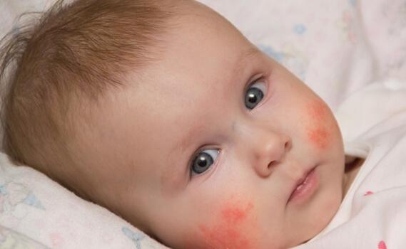 Baby mit atopischer Dermatitis