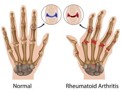 Veranschaulichung gesunder Gelenke und rheumatoider Arthritis