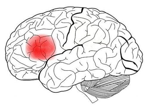 Ein Gehirn mit rot markiertem Broca-Areal.