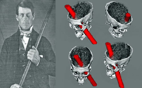 Phineas Gage erlitt einen Schaden am orbitofrontalen Kortex
