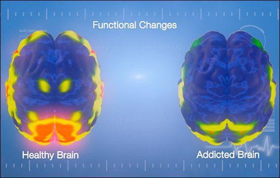 Gesundes und süchtiges Gehirn