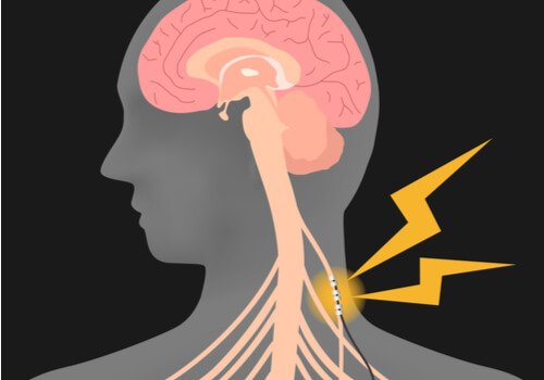 Stimulation des Nervus vagus