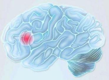 Zeichnung eines menschlichen Gehirns und Symbol für Schlaganfall