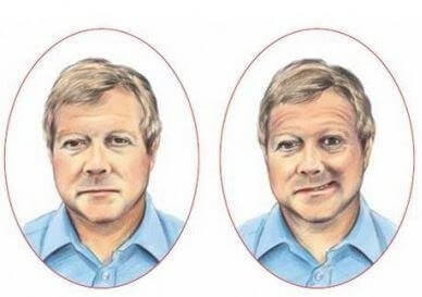 Zwei Bilder eines Mannes. Das eine zeigt ihm beim Versuch des Lächelns, aber er kann nur einen Mundwinkel nach oben ziehen.