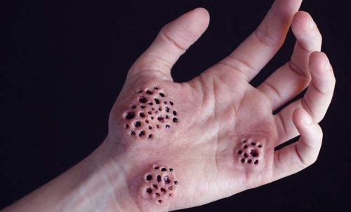 Eine Handinnenfläche, auf der sich Löcher gebildet haben