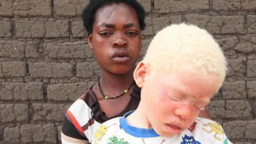 Schwarze Mutter mit Albino-Kind