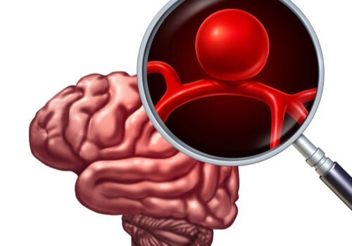 Aneurysma - Gehirn