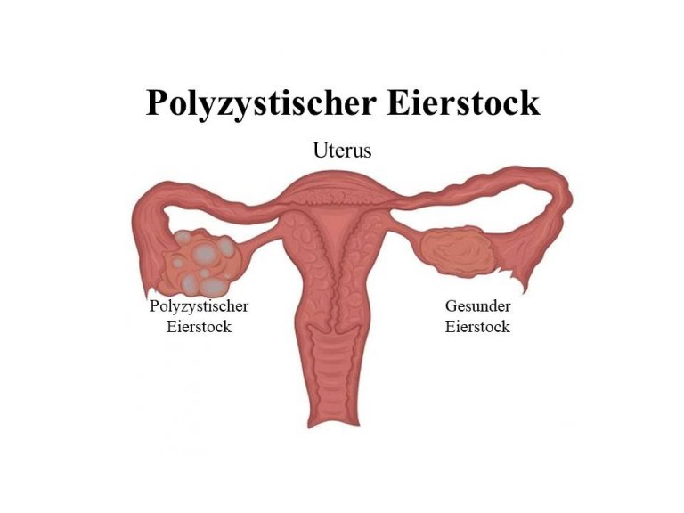 Alles über das polyzystische Ovarialsyndrom