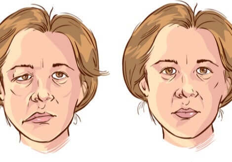 Gesichtslähmung - Zeichnung einer Frau