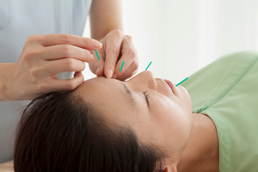 Heilpraktiker behandelt Frau mit Akupunktur