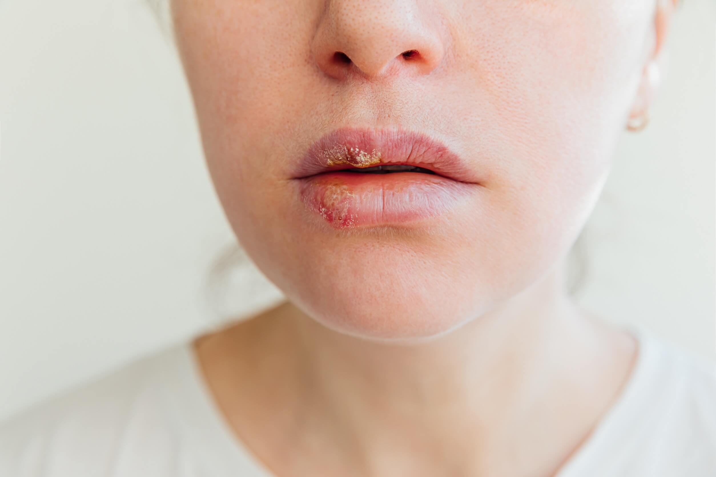 Lippenherpes und gestresste Haut